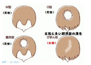 薄毛が気になるなら無料相談で薄毛のタイプを見極める