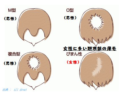 女性の薄毛は頭頂部から薄くなるびまん性脱毛症