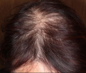 薄毛で地肌が目立つ女性のびまん性脱毛症