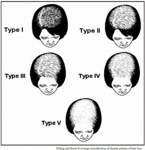 びまん性脱毛症は女性に多い薄毛です