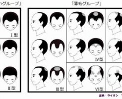 夫の髪が薄くなったと思った時に有効な育毛剤