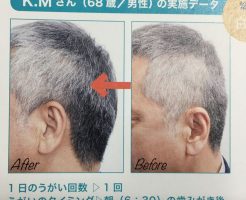 薄毛のビフォーアフターの写真は禁止になる？