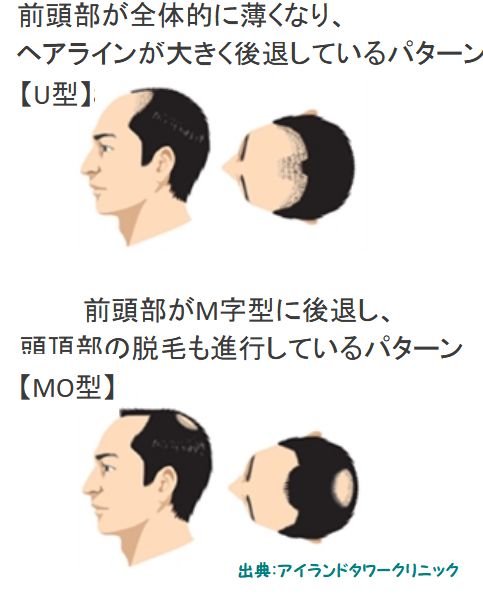 20歳代の男性が最もM字ハゲに悩んでいる | 髪の毛にいい食べ物で若ハゲ克服対策