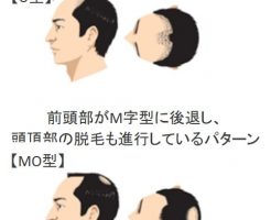 薄毛になりたくないなら薄毛対策は20歳から開始