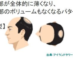 M字ハゲに悩んでいるのは20歳代の男性