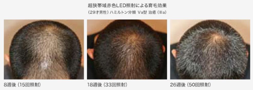 アデランスのヘアリプロの育毛効果は100%だったと報告された