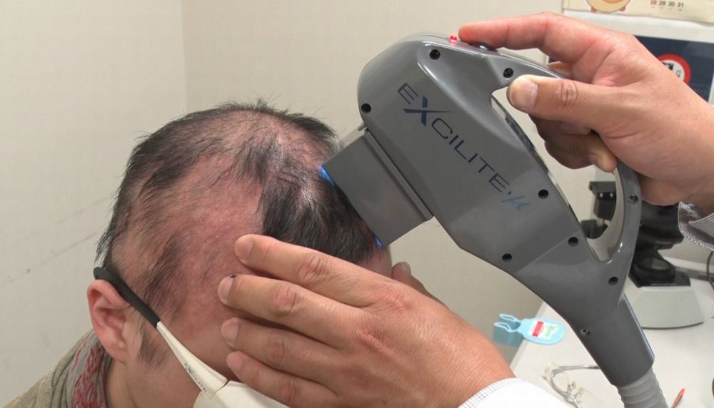 円形脱毛症の最新の治し方｜東京テレビ | 髪の毛にいい食べ物 ...