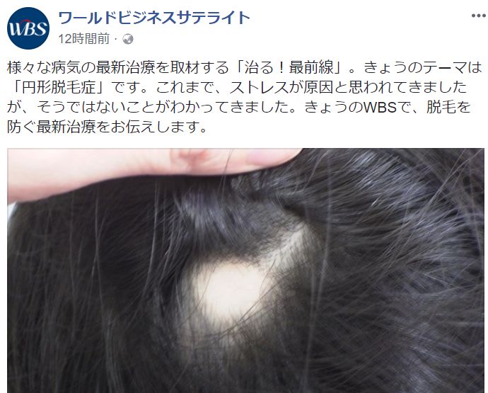 東京テレビでは最新の円形脱毛症の治し方を紹介