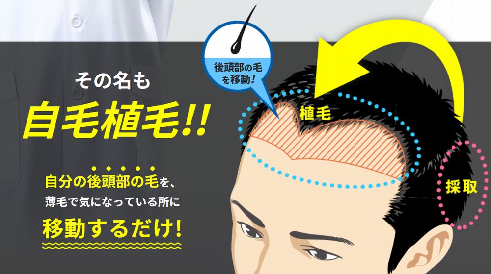日本皮膚科学会の勧める自毛植毛は抜けてもまた生えてくる