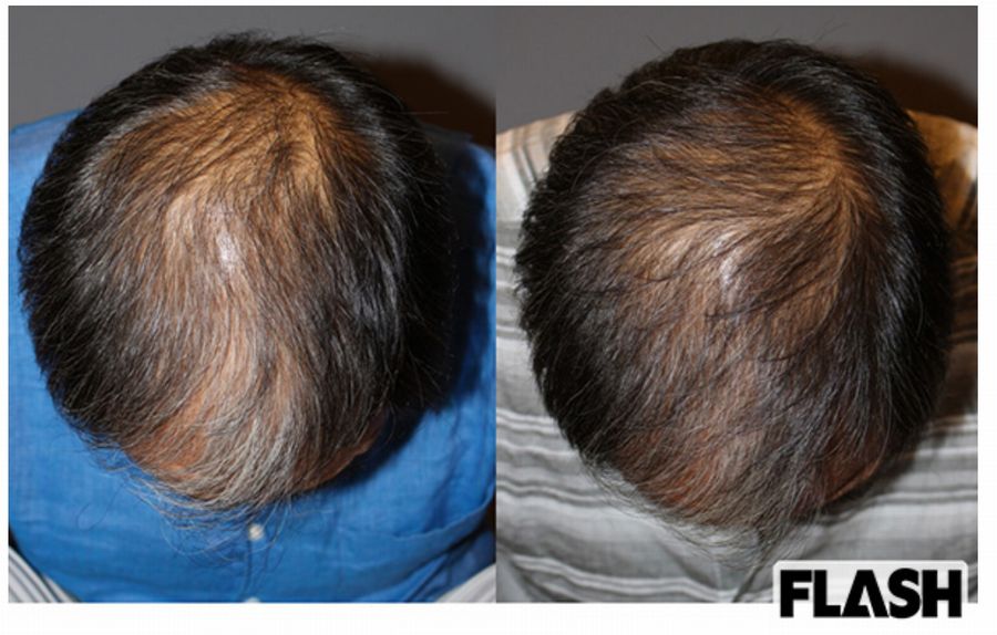 頭髪の再生医療なら安全なアヴェニューセルクリニックの薄毛治療