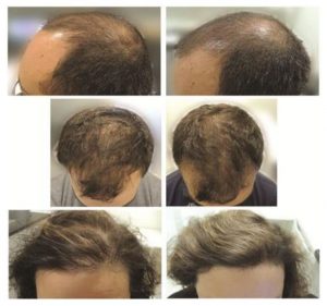 ノコギリヤシの育毛効果に関する科学的論文